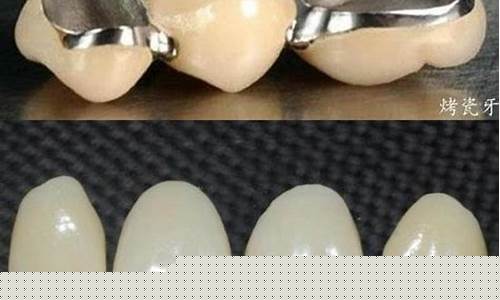 南京烤瓷牙钛合金价格_南京烤瓷牙钛合金价格多少